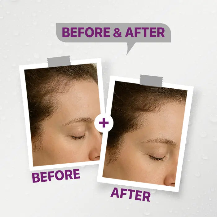 إستوزا أقراص ( حديد )