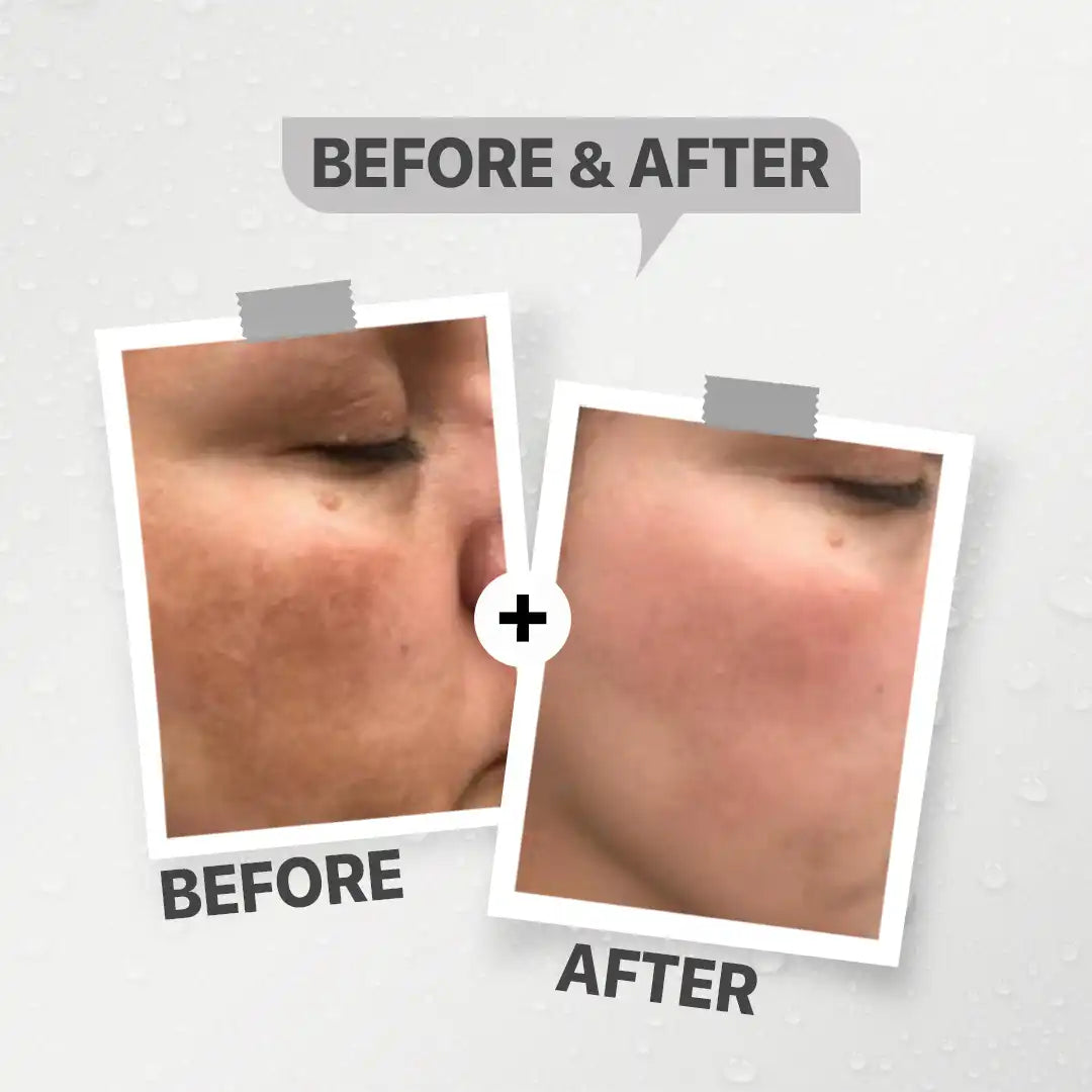 سي ليت معالج للبقع التصبغت