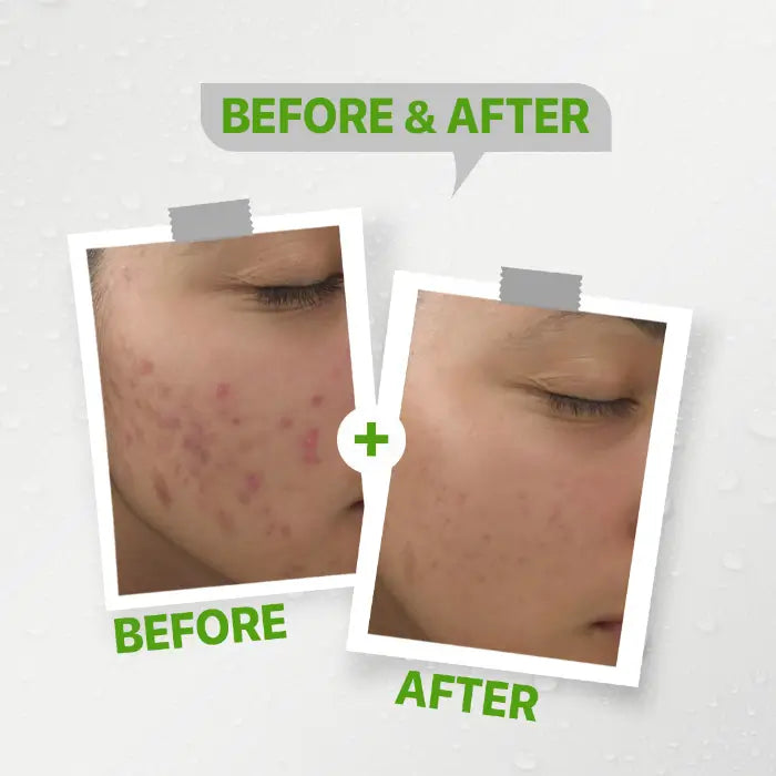 Vetaply Acne Cream